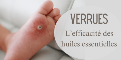 Verrues: l'efficacit&eacute; des huiles essentielles
